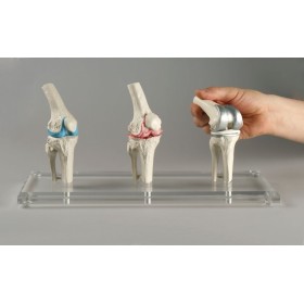 Modèle implant genou