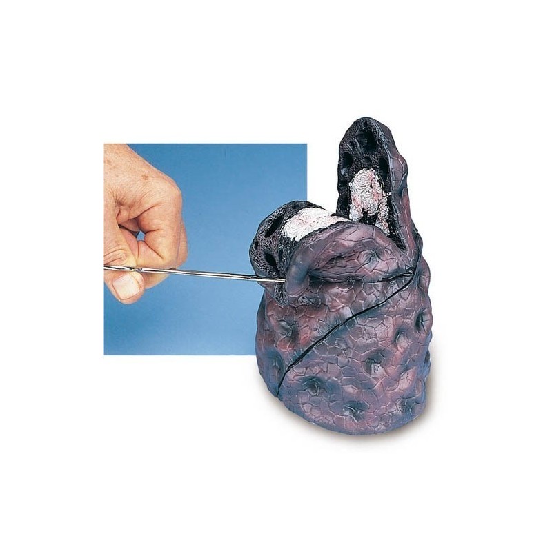 Modèle de Cancer du poumon