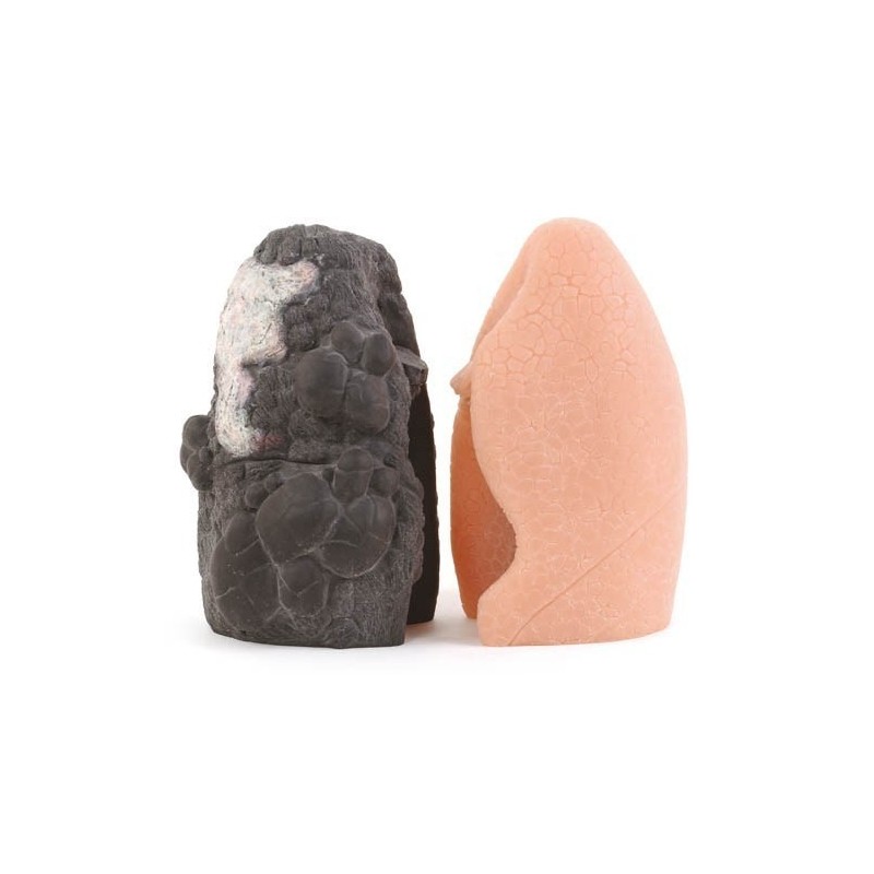 Modèle anatomique de comparaison du cancer du poumon