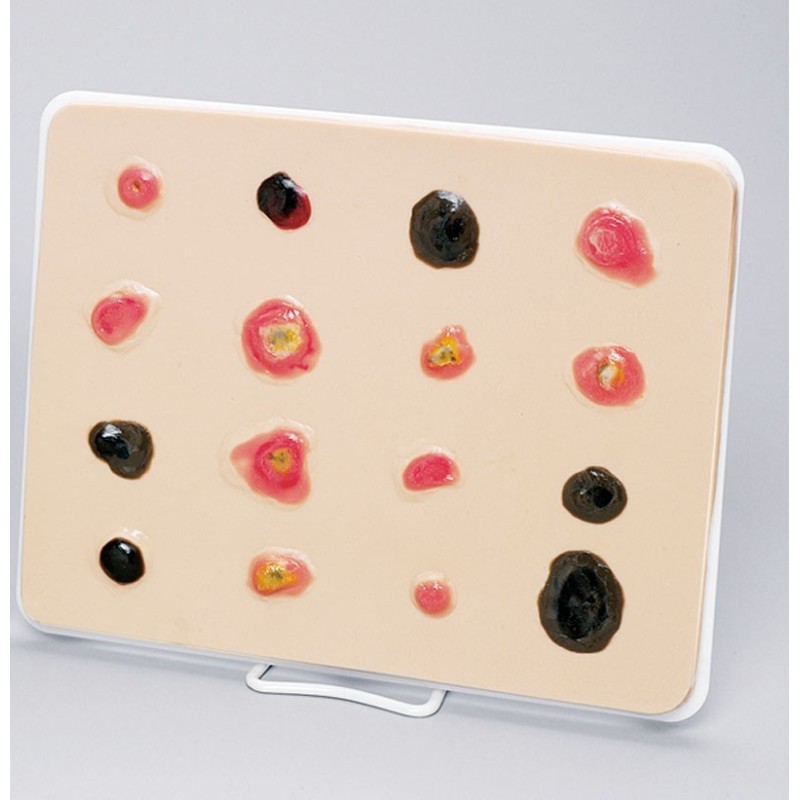 Modele anatomique de cancer de la peau