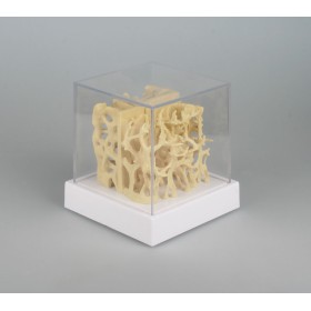 Modèle comparatif d'un os sain et d'un os atteint d'ostéoporose