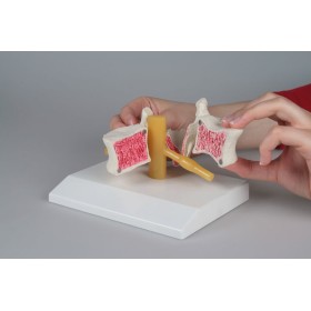 Vertèbres avec ostéoporose, deux pièces 