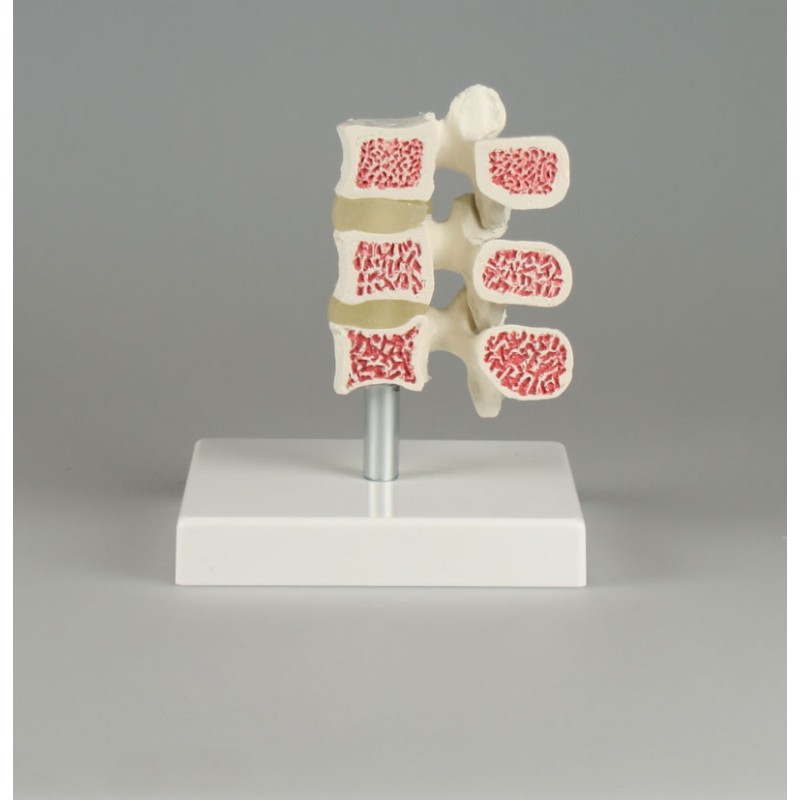 Modèle de vertèbres à ostéoporose, 3 vertèbres 