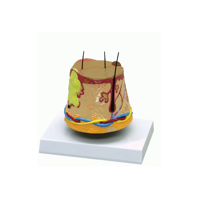 Modèle anatomique de l'acné -