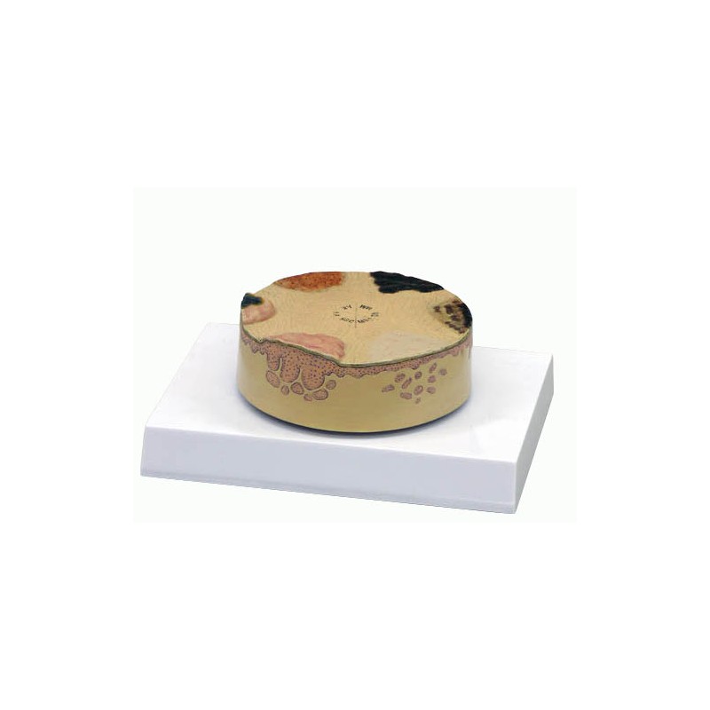 Modèle anatomique de cancer de la peau -