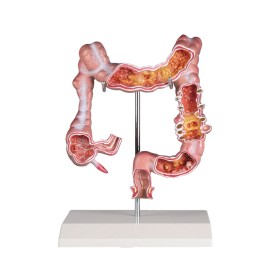 Modèle de maladies du collon 